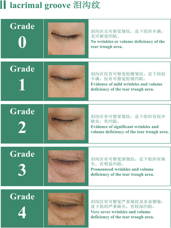 中國(guó)女性淚溝紋分級(jí)標(biāo)準(zhǔn)-上海市皮膚病醫(yī)院